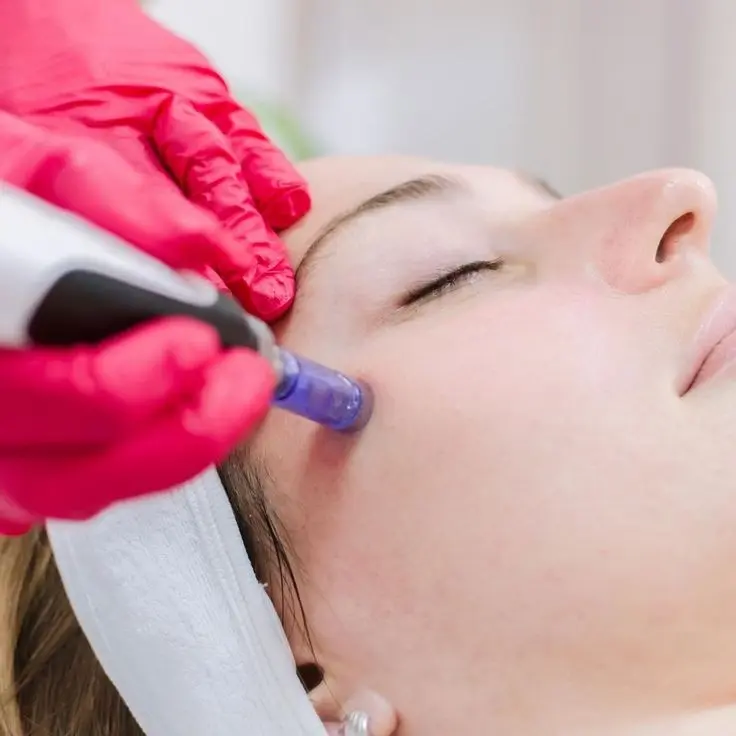 Microneedling protocolo  Casmara